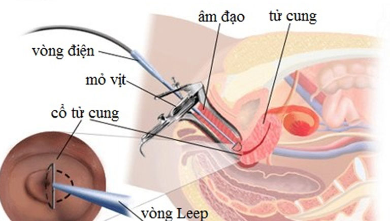 Các biện pháp điều trị ung thư cổ tử cung