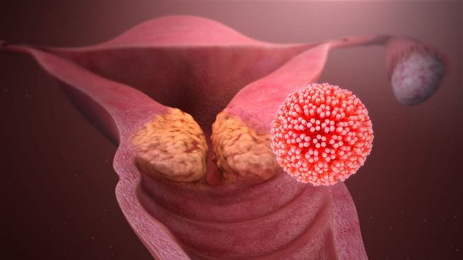 Bệnh ung thư cổ tử cung có lây hay di truyền không?