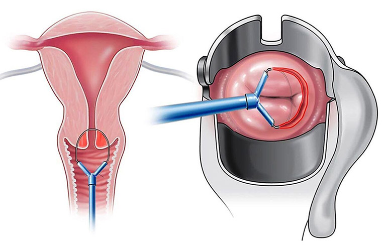 Sinh thiết chóp cổ tử cung là một trong những kỹ thuật sinh thiết cổ tử cung cơ bản, được phần đông bác sĩ chỉ định