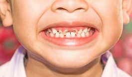 Theo số liệu thống kê cho thấy, ở nước ta tỷ lệ trẻ em bị sâu răng đang chiếm khoảng 79%