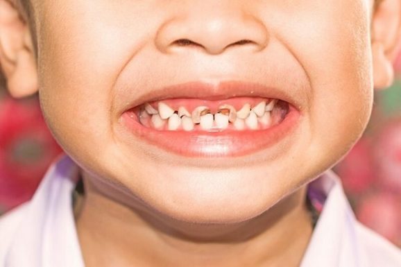 Theo số liệu thống kê cho thấy, ở nước ta tỷ lệ trẻ em bị sâu răng đang chiếm khoảng 79%