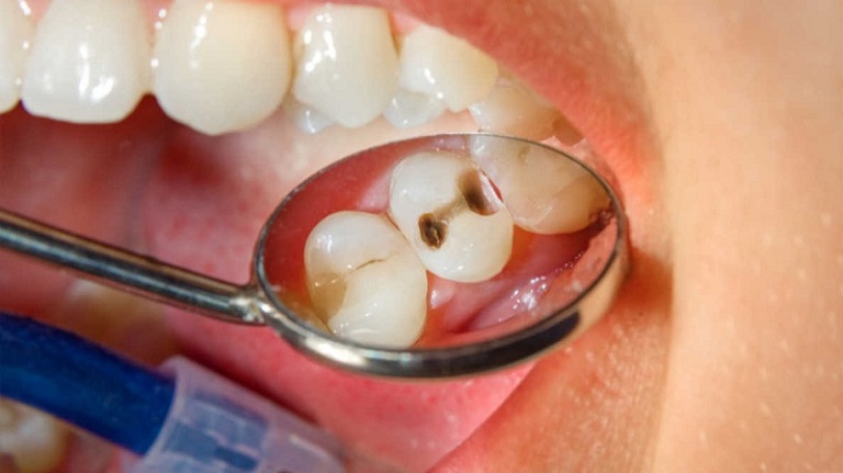 các mức độ sâu răng