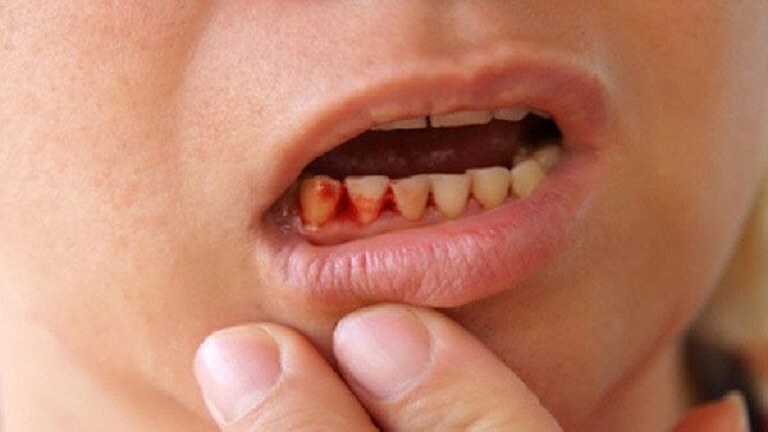 Đau nhức răng nếu không điều trị kip thời có thể gây ra nhiều biến chứng