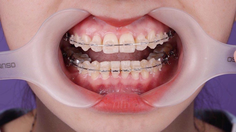 Dây cung niềng răng là gì