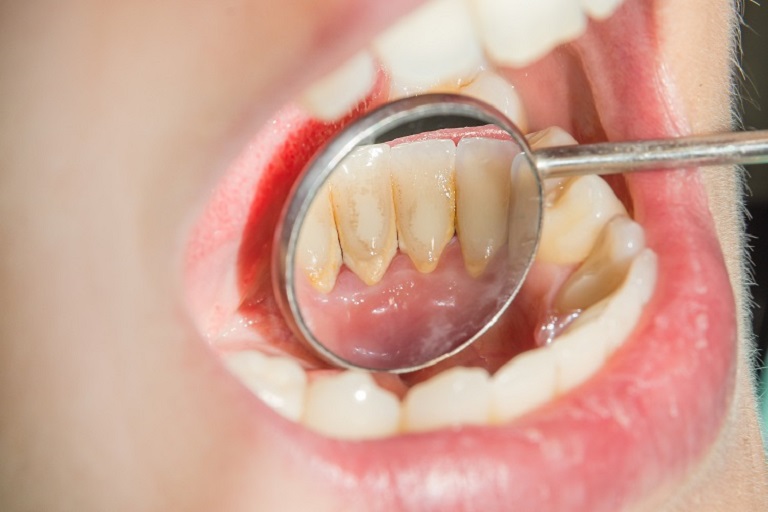 Sâu răng cửa nguyên nhân do vôi răng lâu ngày tích tụ
