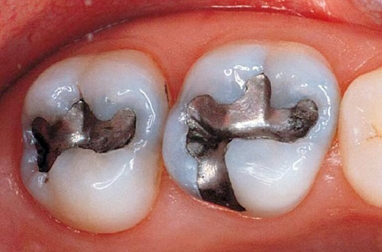 Trám răng được biết tới là kỹ thuật phổ biến trong việc điều trị sâu răng.
