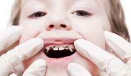Sâu răng trẻ em là hiện tượng vi khuẩn tấn công khiến cho men răng bị tác động