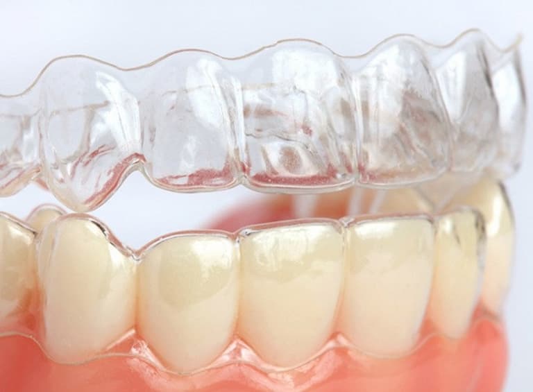 Niềng răng không mắc cài 3D Clear: Hiệu quả, quy trình và mức giá
