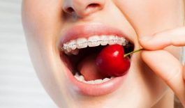 Niềng răng nên ăn gì? Gợi ý thực đơn phù hợp nhất cho người mới