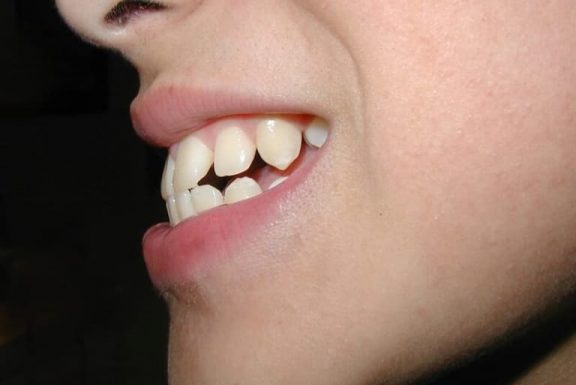 Răng hô nhẹ là gì? Các biện pháp khắc phục hiệu quả bạn nên biết