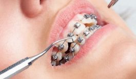 Niềng răng bị tụt lợi có nguyên nhân do đâu và các cách khắc phục