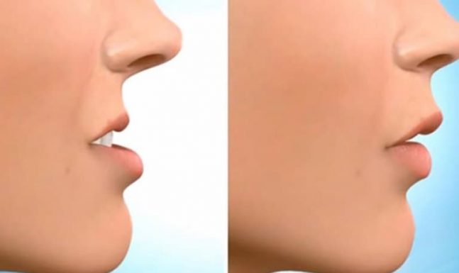Niềng răng trước và sau có gì khác biệt, bạn đã biết hay chưa?