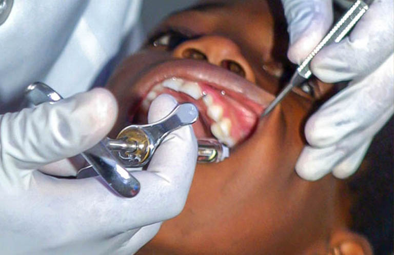Chẩn đoán và điều trị áp xe quanh chân răng có ổ