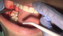 Mức độ nguy hiểm của bệnh áp xe răng