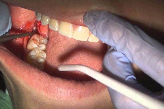 Mức độ nguy hiểm của bệnh áp xe răng