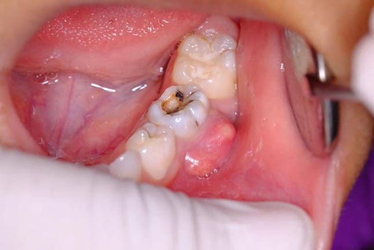 Áp xe răng khôn là gì? Phân loại