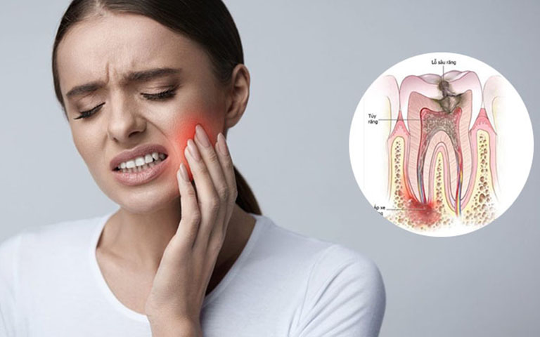 Triệu chứng nhận biết áp xe răng khôn