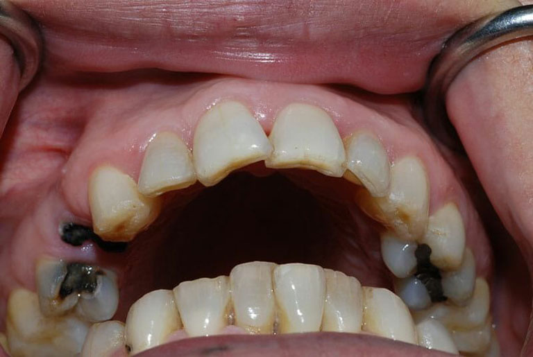 Chi phí điều trị áp xe răng hết bao nhiêu?