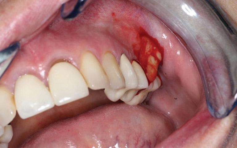 Vỡ áp xe răng là gì?