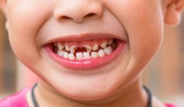 Chữa sâu răng ở trẻ em có thật sự cần thiết?