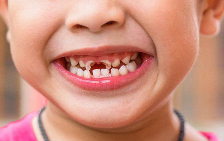 Chữa sâu răng ở trẻ em có thật sự cần thiết?