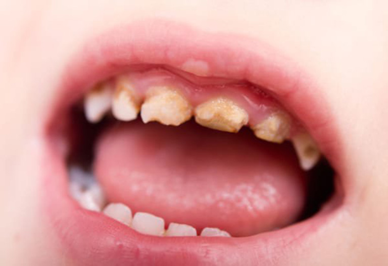 Gợi ý cách chữa sâu răng ở trẻ em đơn giản