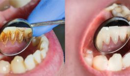 Cao răng là gì? Cách nhận biết cao răng