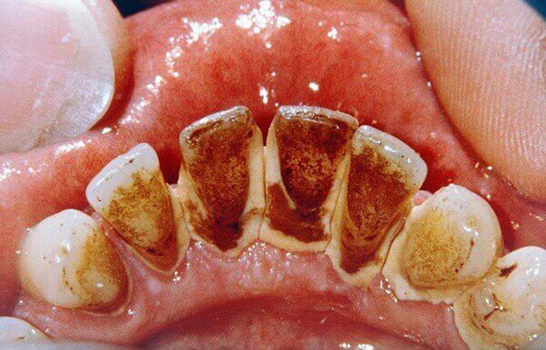 Cao răng là gì? Cách nhận biết cao răng