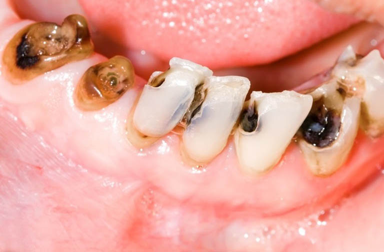 Tác dụng chữa sâu răng của cà độc dược