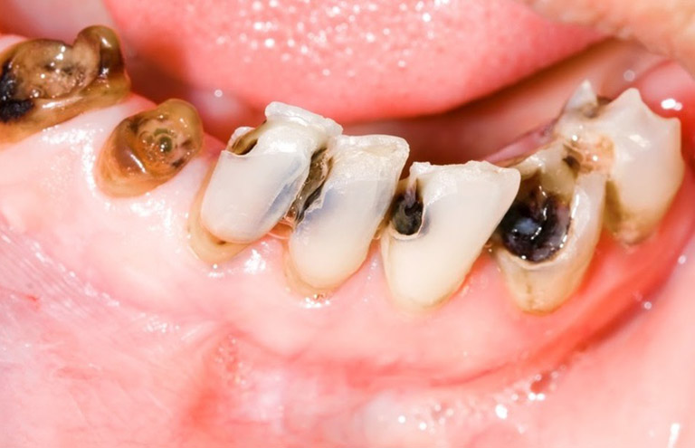 Sự thật về con sâu răng là gì?