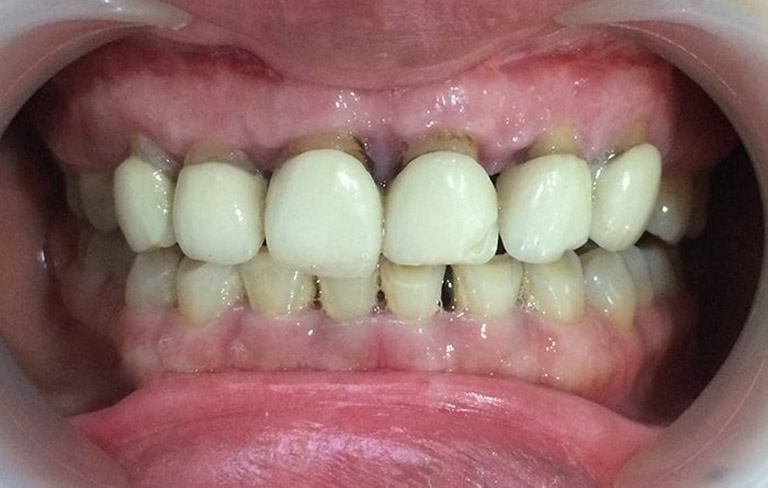 Kẽ răng bị hôi có nguy hại không?