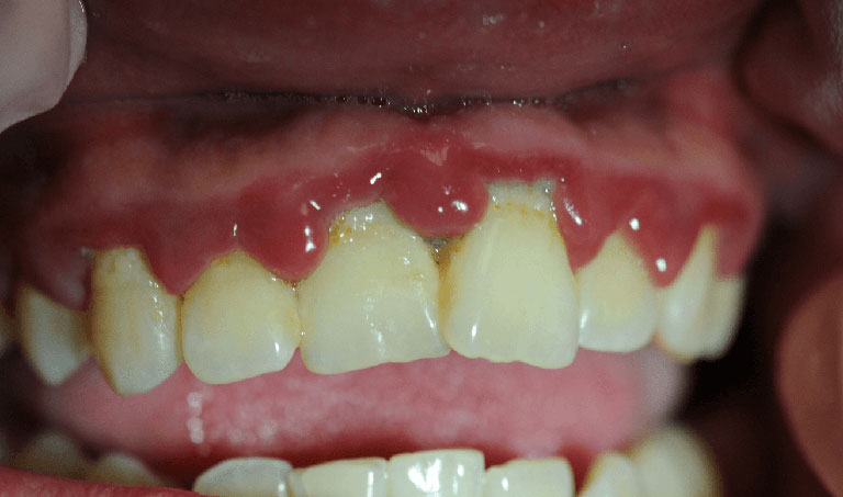 răng ê buốt kéo dài do bệnh viêm lợi