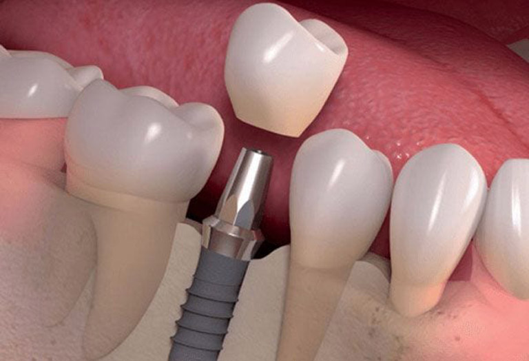 Cách khắc phụ tình trạng răng giả bị hôi
