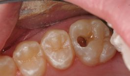 Sâu răng hàm là gì?