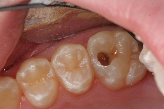 Sâu răng hàm là gì?