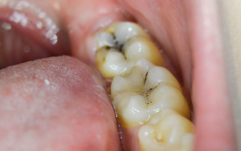 Sâu răng hàm có nên nhổ không?