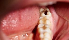Sâu răng số 8 là gì? Nguyên nhân gây bệnh