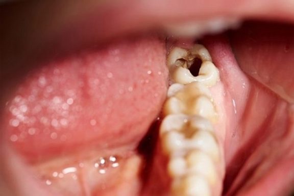 Sâu răng số 8 là gì? Nguyên nhân gây bệnh