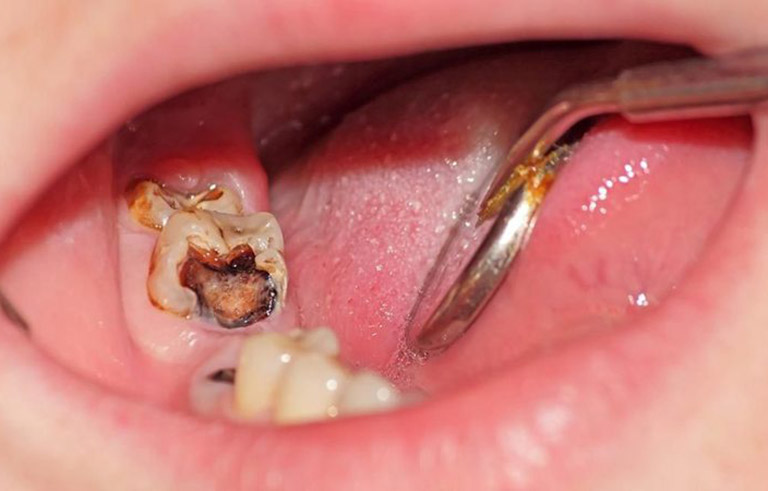 Sâu răng số 8 có nguy hiểm không?