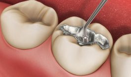 Thông tin cơ bản về thủ thuật trám răng