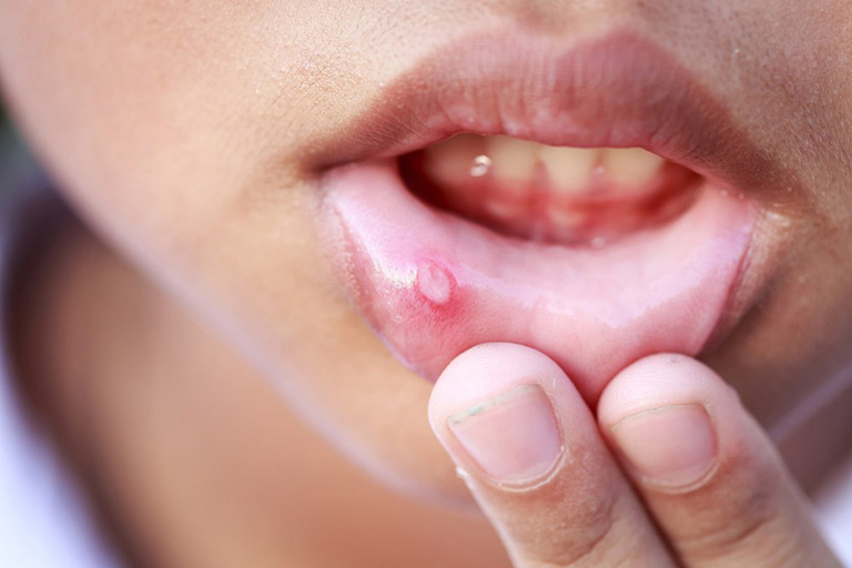 Viêm loét miệng là gì? Đối tượng thường mắc phải