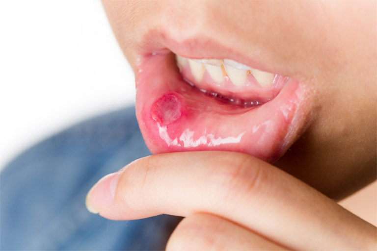 Nguyên nhân gây viêm loét miệng