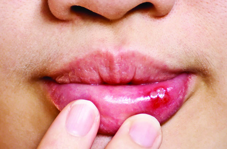 Viêm loét miệng có nguy hiểm không?