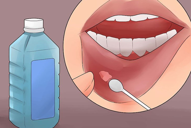 Cách chữa trị viêm loét miệng an toàn