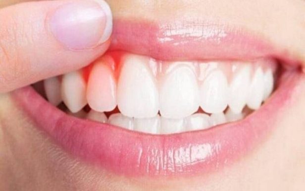 Viêm Nha Chu Cấp Là Gì? Triệu Chứng và Hướng Điều Trị