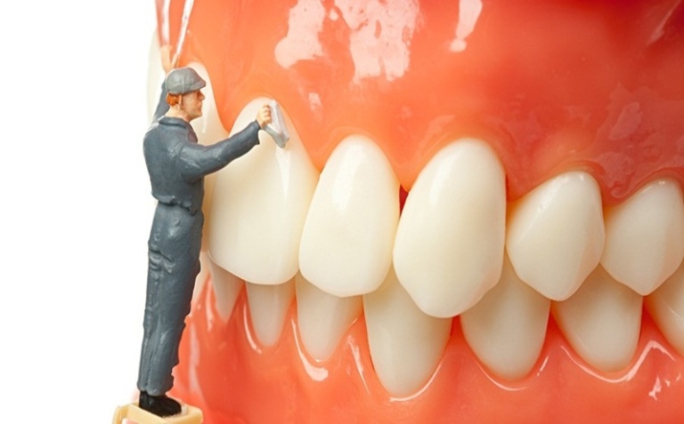 Giải pháp điều trị viêm nha chu làm răng lung lay
