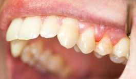 Viêm nướu răng là gì?
