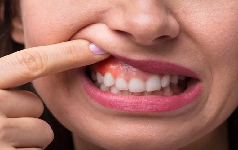 Viêm nướu răng có nguy hiểm không?