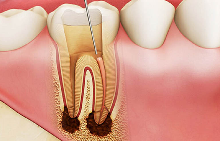 Viêm tủy răng - Các vấn đề thường gặp