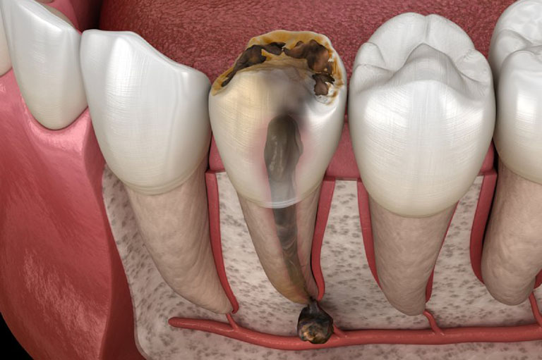 Viêm tủy răng có mủ là gì? Nguy hiểm như thế nào?